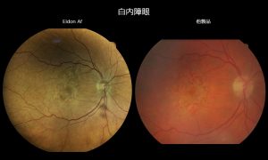 白内障眼撮影比較