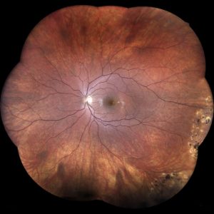 Laser Treatment