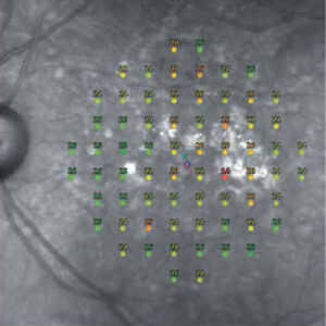 中間期加齢黄斑変性