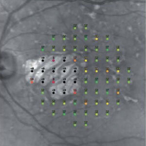 スターガルト病