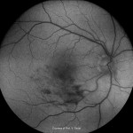 自発蛍光画像(Eidon Af)