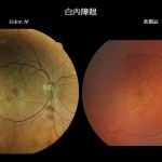 白内障眼撮影比較 白内障眼撮影比較