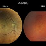 白内障眼撮影比較