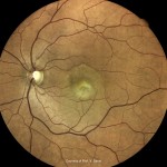 加齢黄斑変性 加齢黄斑変性