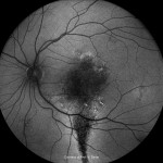 中心性漿液性脈絡網膜症(AF) 中心性漿液性脈絡網膜症(AF)