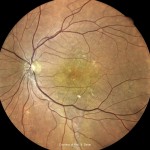 中心性漿液性脈絡網膜症 中心性漿液性脈絡網膜症