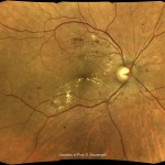 増殖前糖尿病網膜症 増殖前糖尿病網膜症