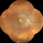 Stargardt病 Stargardt病