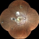 結核性網脈絡膜炎 結核性網脈絡膜炎