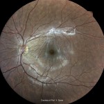 硝子体黄斑牽引症候群 硝子体黄斑牽引症候群