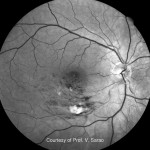 レッドフリー レッドフリー