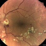 網膜静脈閉塞症 網膜静脈閉塞症