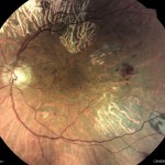 増殖性糖尿病網膜症 増殖性糖尿病網膜症