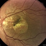 白内障+AMD 白内障+AMD