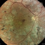 糖尿病網膜症 糖尿病網膜症