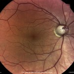 緑内障2 緑内障2