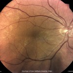 黄斑変性 黄斑変性