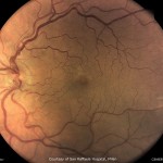 点状出血+毛細血管瘤 点状出血+毛細血管瘤