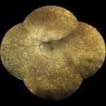 糖尿病網膜症 糖尿病網膜症