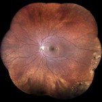 レーザー治療 Laser Treatment