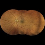 網膜静脈閉塞症 網膜静脈閉塞症