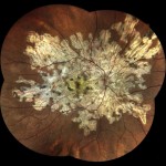 蛇行性脈絡膜炎 蛇行性脈絡膜炎