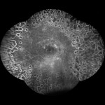 糖尿病網膜症 FA 糖尿病網膜症 FA