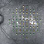 中間期加齢黄斑変性 中間期加齢黄斑変性