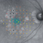 地図状萎縮 地図状萎縮