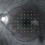網膜色素変性症 網膜色素変性症